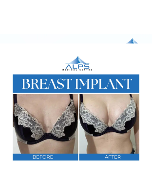 Breast Surgery - Augmentation, Reduction, Lift | 5 days 4 Nights Stay