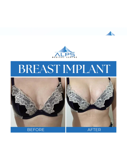 Breast Surgery - Augmentation, Reduction, Lift | 5 days 4 Nights Stay