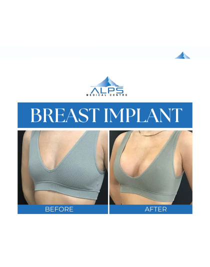 Breast Surgery - Augmentation, Reduction, Lift | 5 days 4 Nights Stay