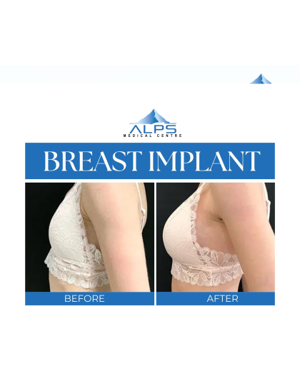 Breast Surgery - Augmentation, Reduction, Lift | 5 days 4 Nights Stay