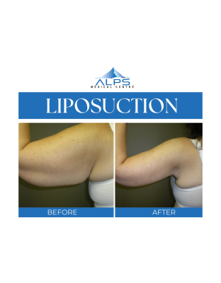 Liposuction