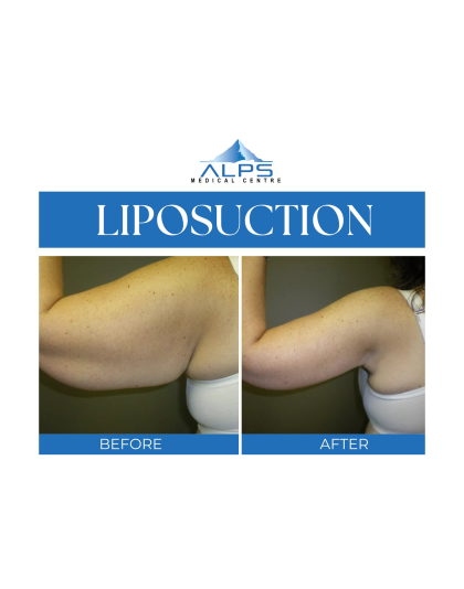 Liposuction