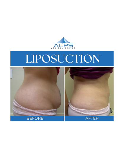 Liposuction