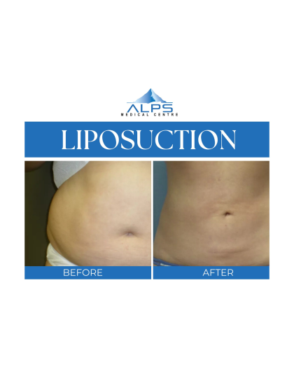 Liposuction
