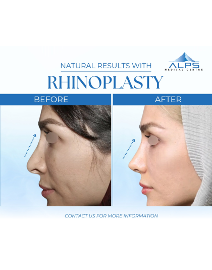 Face Surgery - Rhinoplasty, Nasal Work