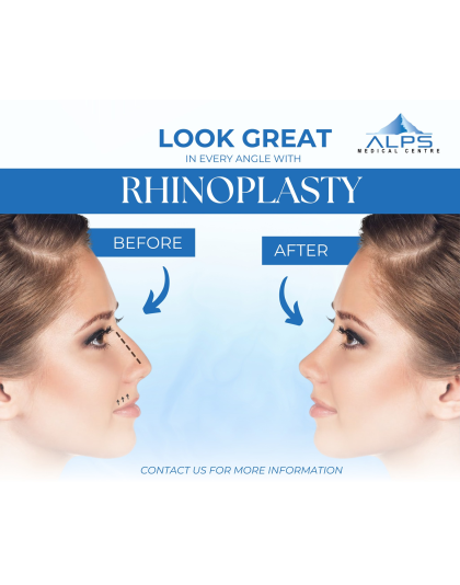 Face Surgery - Rhinoplasty, Nasal Work